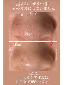 コルッソ(CoLusson.)の写真/小鼻のザラつきをリセット。お顔全体の開き毛穴をキュッと引き締め「つるん」とした素肌へ！