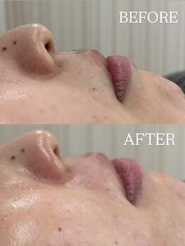 ラキ(LAKI)/フェイシャルワックス