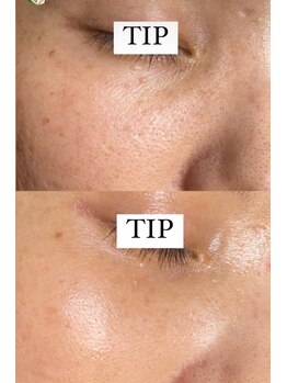 プランス 恵比寿店(PLANCE)/頬や目元のお悩み