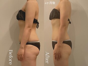 ユーフォリア グロウ(euphoria glow)/{ ラフォス痩身90分 24回 }