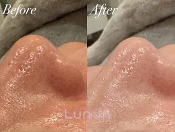 ルノン(Lunon)/毛穴洗浄ハイドロ