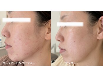 マロン(MARON)の写真/初めての方も安心♪大人女性のためのプライベート空間で、理想の肌質改善ピーリング体験を！◎