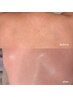 【期間限定価格】背中Wax脱毛+艶モチ生パック ¥10000→¥7000