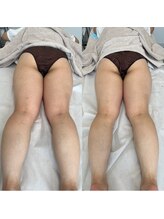 リリー(Lily)/施術1回目