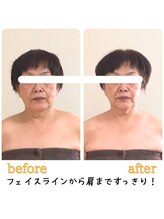 ティアラ/before after　[デトリム]