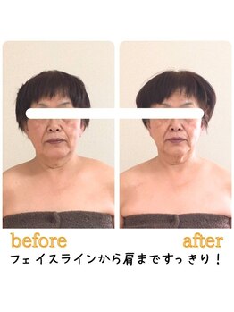ティアラ/before after　[デトリム]