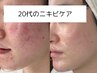 【学割U24】しつこいニキビに速攻アプローチ、褒められ艶肌に♪◎越谷