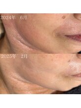 サロン ド エン(Salon de. en)/肌荒れケ◇ハーブピーリング