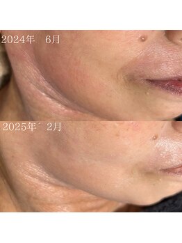 サロン ド エン(Salon de. en)/肌荒れケ◇ハーブピーリング