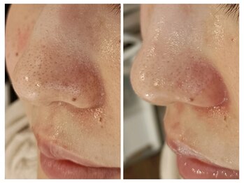 ベリッセ(Belisse)/ハイドラ毛穴洗浄