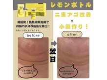 ホープ(Hope)の雰囲気（二重あごやフェイスラインのモタツキにレモンボトル効果を発揮！）