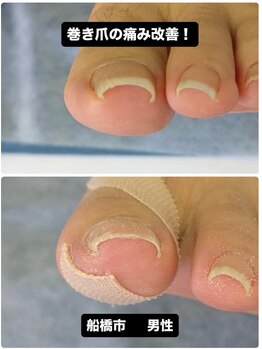 巻き爪に悩む方が笑顔に！