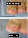 巻き爪に悩む方が笑顔に!