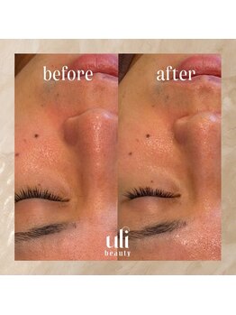 ウリ(uli beauty)/比較写真