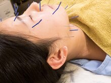 いなほ はりきゅう整骨院 東新宿/美容鍼施術/手順10