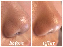 ヴィラアンドテラス(Villa×terrace)の雰囲気（オプション『毛穴洗浄』は¥1,320～☆美容液で毛穴を洗うエステ）