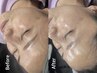 人気No.1 30代【シミ・たるみ・ほうれい線】ララピール＋毛穴洗浄※男女可