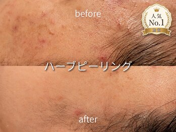 デディア(dedia)の写真/【リピート続出！】都度払い可能で通いやすい★大人気ハーブリーリングで毛穴を根本改善しませんか？