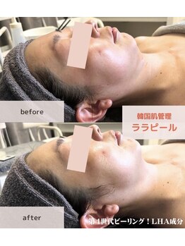 コスメティックスアンドビューティ グランディール/【ララピール】一回の効果です！