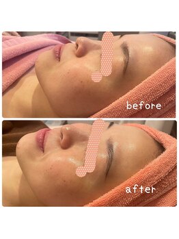 ヒメミ(Himemi)/BBL光エステ