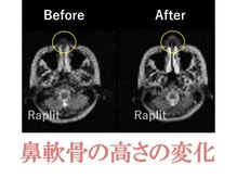 ラプリボヤージュ 藤沢店(Raplit)/ 隆鼻＋輪郭矯正40分7回