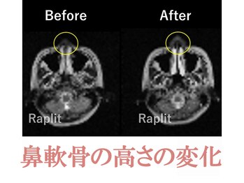 ラプリボヤージュ 藤沢店(Raplit)/ 隆鼻＋輪郭矯正40分7回