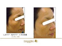 エステサロン リアルケー(Real K)/シャルム・ボービフォーアフター