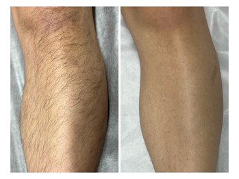 サロン ラズリ 久留米店(SALON Lazuli)/【メンズ脱毛】VIO不可