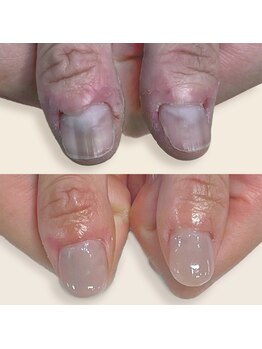 ハッカネイル(HAKKA NAIL)の写真/深爪、噛み癖やむしり癖のある方に。手元を隠さない自信のある指先へ★理想のお爪へサポートいたします♪