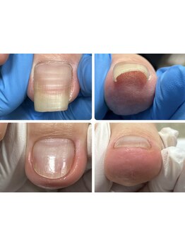 爪の悩みを解消できる（ケア含む）