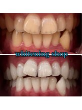 ホワイトニングショップ 京都駅前店/40分×10回Before/After