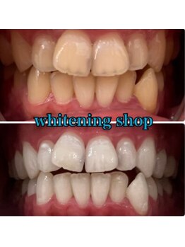 ホワイトニングショップ 京都駅前店/40分×10回Before/After