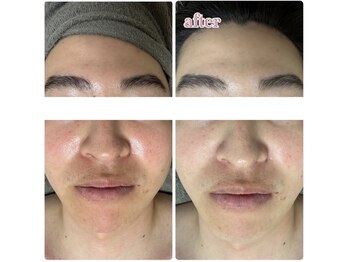 ベラピエル(BELLA Piel)/毛穴・くすみ・赤ら顔・しみケア