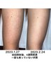 【メンズ脱毛足全体】¥12,000→¥8,500