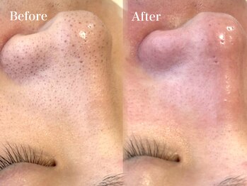 ファミーユ 太田(Fameu)/毛穴洗浄