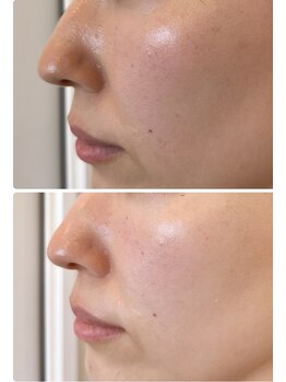 シェノン(Chainon)/1回で黒ずみ毛穴・角栓改善!