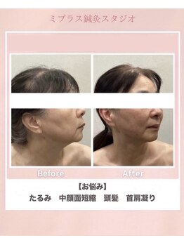 ミプラス鍼灸スタジオ/ビフォーアフター