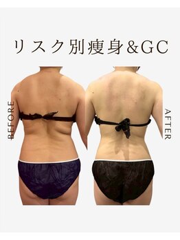ビーシェイプ 君津(B-Shape)/【痩身】ビフォーアフター