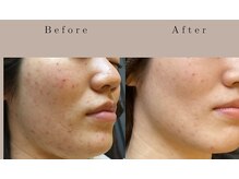 なごみ/肌質改善【ハーブピーリング】