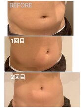 トータルケア・マッサージ 都立大学/痩身マシン・参考写真（2）