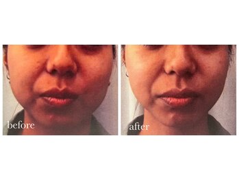 サロン ド ラム/【光フェイシャル】1回目