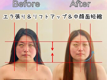リストアハート(Restore Heart)/エラ張り&リフトアップ&中顔面