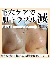ピュール 鯖江店(PUR)/毛穴サロン/毛穴洗浄/毛穴ケア