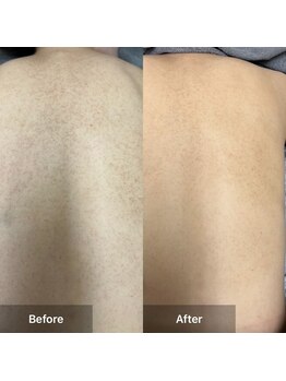 モカ 天王寺店(MOKA)/剥離ハーブピーリングニキビケア