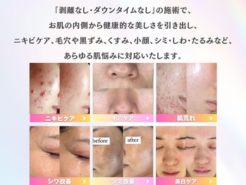 ホワイトアクア 成田店(WHITE AQUA)/ハーブピーリング/毛穴/成田