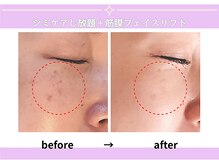 カピリナスパ(Ka.Pilina Spa)/シミケア3回目　before⇒after