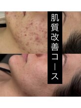 ソアン(Soin)/肌質改善コース