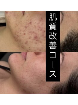 ソアン(Soin)/肌質改善コース