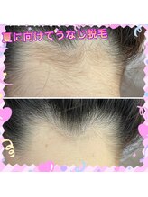 ダリア 瑞穂(DAHLIA)/夏に人気うなじ脱毛