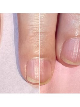 ココデネイル(cocode nail)/悩み:爪が欠ける(40代後半)